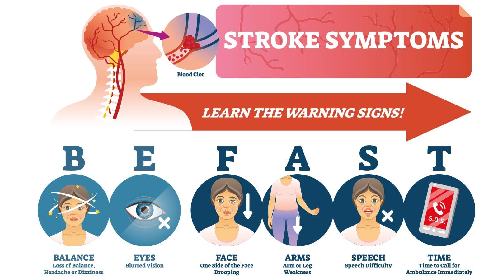 An illustration about the symptoms of stroke