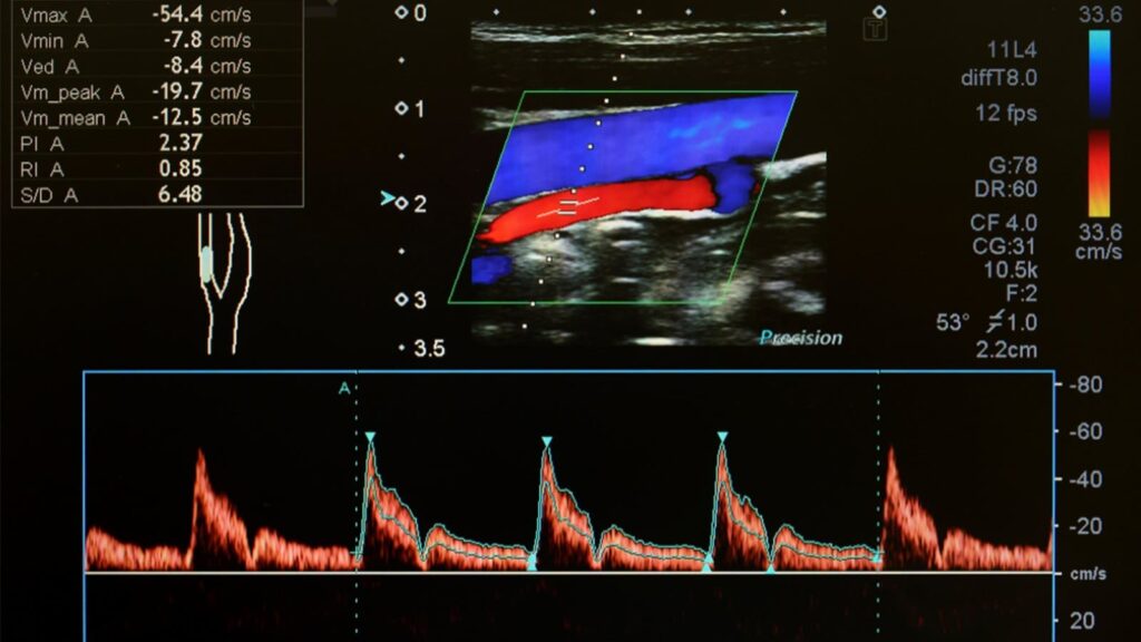 Image of doppler ultrasound results