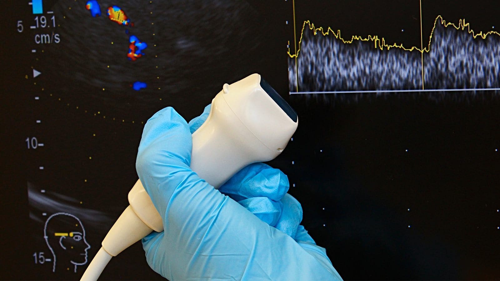 Transcranial Doppler Ultrasound - A&B Neurology