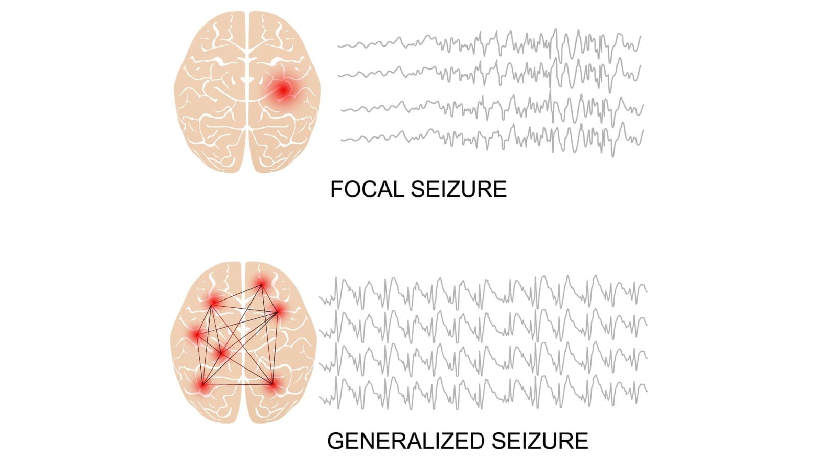 Illustration of an EEG of the different types of seizures