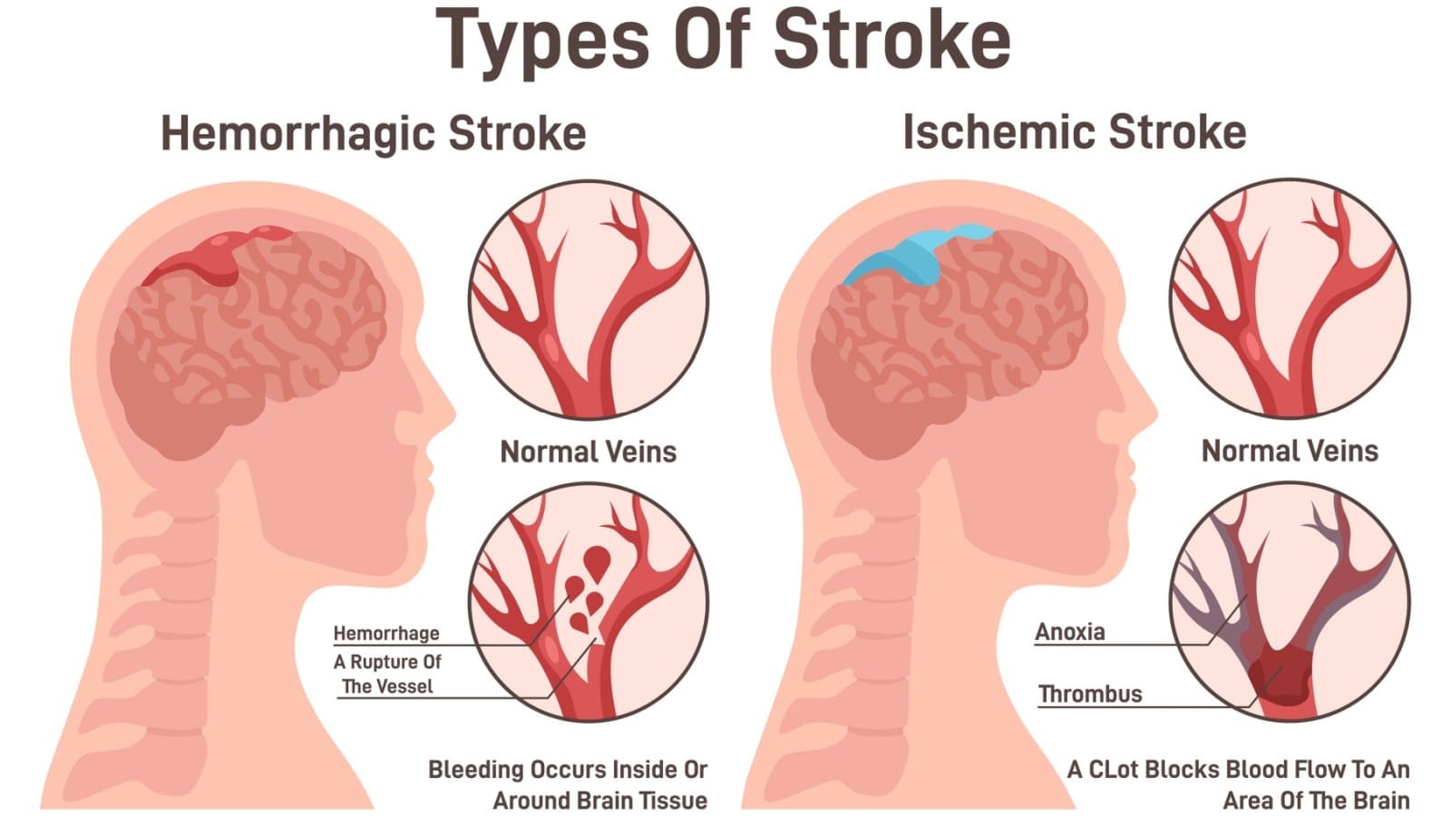 An illustration about the types of stroke